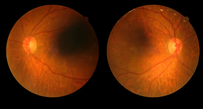 Diabetic Retinopathy Treatment